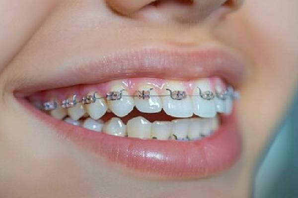 Dental Braces